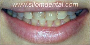 Before Porcelain Veneers, Dental Veneer Bangkok Dental Clinic