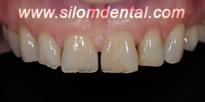 Before Porcelain Veneers, Dental Veneer Thailand Dental Clinic