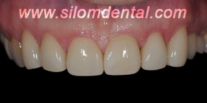 After Porcelain Veneers, Veneers Dental Clinic Bangkok