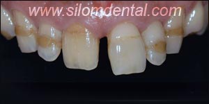 Before Porcelain Veneers, Dental Veneer Thailand Dental Clinic