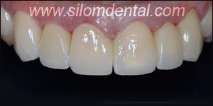 After Porcelain Veneers, Veneers Dental Clinic Bangkok