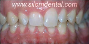 Before Porcelain Veneers, Dental Veneer Bangkok Dental Clinic