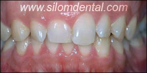 Before Porcelain Veneers, Dental Veneer Bangkok Dental Clinic