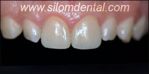 After Porcelain Veneers, Veneers Dental Clinic Thailand