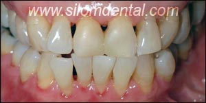 Before Porcelain Veneers, Dental Veneer Thailand Dental Clinic