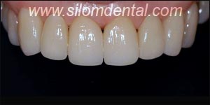 After Porcelain Veneers, Veneers Dental Clinic Bangkok