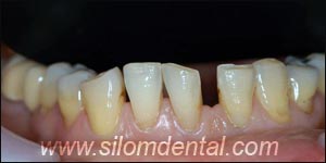 Before Porcelain Veneers, Dental Veneer Thailand Dental Clinic