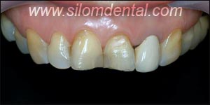 Before Porcelain Veneers, Dental Veneer Bangkok Dental Clinic