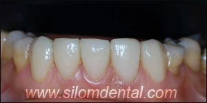 After Porcelain Veneers, Veneers Dental Clinic Bangkok