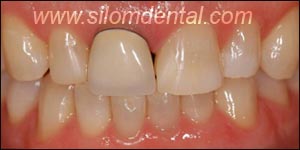 Before Porcelain Veneers, Dental Veneer Bangkok Dental Clinic