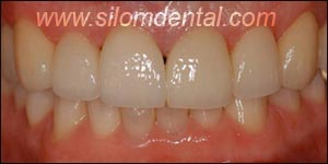 After Porcelain Veneers, Veneers Dental Clinic Thailand