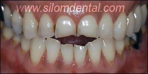 Before Porcelain Veneers, Dental Veneer Thailand Dental Clinic