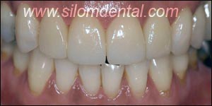 After Porcelain Veneers, Veneers Dental Clinic Bangkok