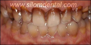 Before Porcelain Veneers, Dental Veneer Bangkok Dental Clinic