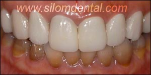 After Porcelain Veneers, Veneers Dental Clinic Thailand