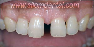 Before Porcelain Veneers, Dental Veneer Thailand Dental Clinic