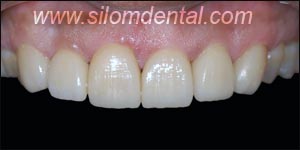 After Porcelain Veneers, Veneers Dental Clinic Bangkok