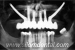 Zygoma Implants