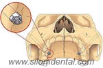 Zygoma Implants