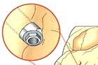 position of zygoma implant