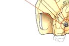 position of zygoma implant