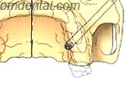 position of zygoma implant