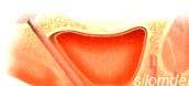zygoma implant