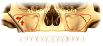 zygoma implant installation