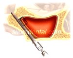 zygoma implant installation