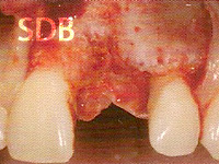 Visible bone defect after flap elevation