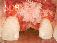 Filling the defect after implant placement