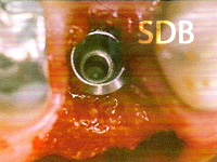 Complete regeneration of the defect 8 months postoperatively