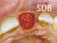 Insertion to the level of the crestal bone margin