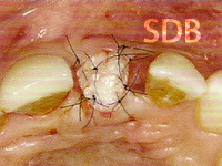 Covering the socket with a soft tissue graft
