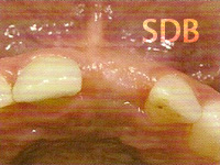 Good soft-tissue situation 6 weeks postoperatively allows for implantplacement