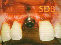 Bone loss over apical implant thread