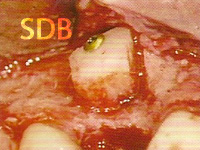 Corticocancellous bone graft from the chin region