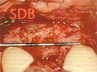 Suitable bone site for implant insertion 6 months postoperatively