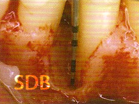 2-wall bone defect with a vertical dimension of approx. 9 mm.