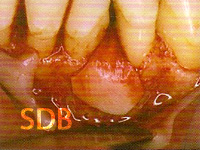 Application of Geistlich Bio-Oss Perio over the defect