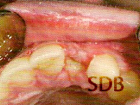 Soft-tissue dehiscence occurring