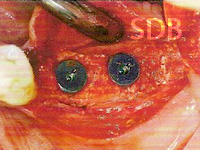 Optimal bone support for implant insertion 6 months postoperatively