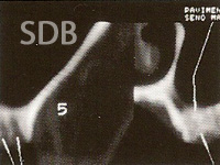 Computed tomogram shows horizontal and vertical bone deficit