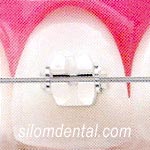 clarity sl self ligating braces