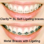 clarity sl self ligating brackets