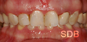 before composite facing