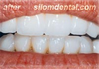 after dental extreme makeovers, dental bridges bangkok