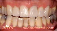 After Dental Makeover, dental crowns thailand