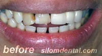 Before Dental Extreme Makeovers, dental crown clinic bangkok thailand