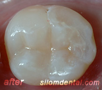 after composite filling
